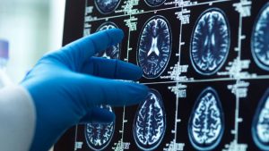 发现为患有罕见和严重癫痫的儿童带来了希望