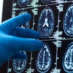 发现为患有罕见和严重癫痫的儿童带来了希望